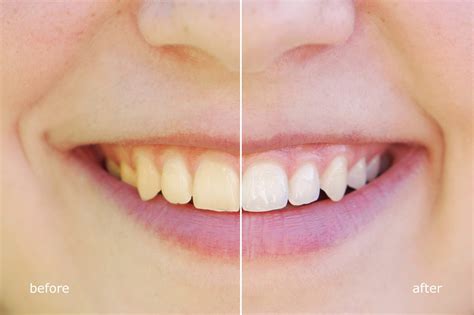 Magic teeth whitening: debunking common myths and misconceptions